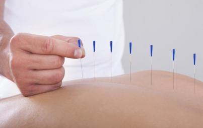 acupuncture for pain relief